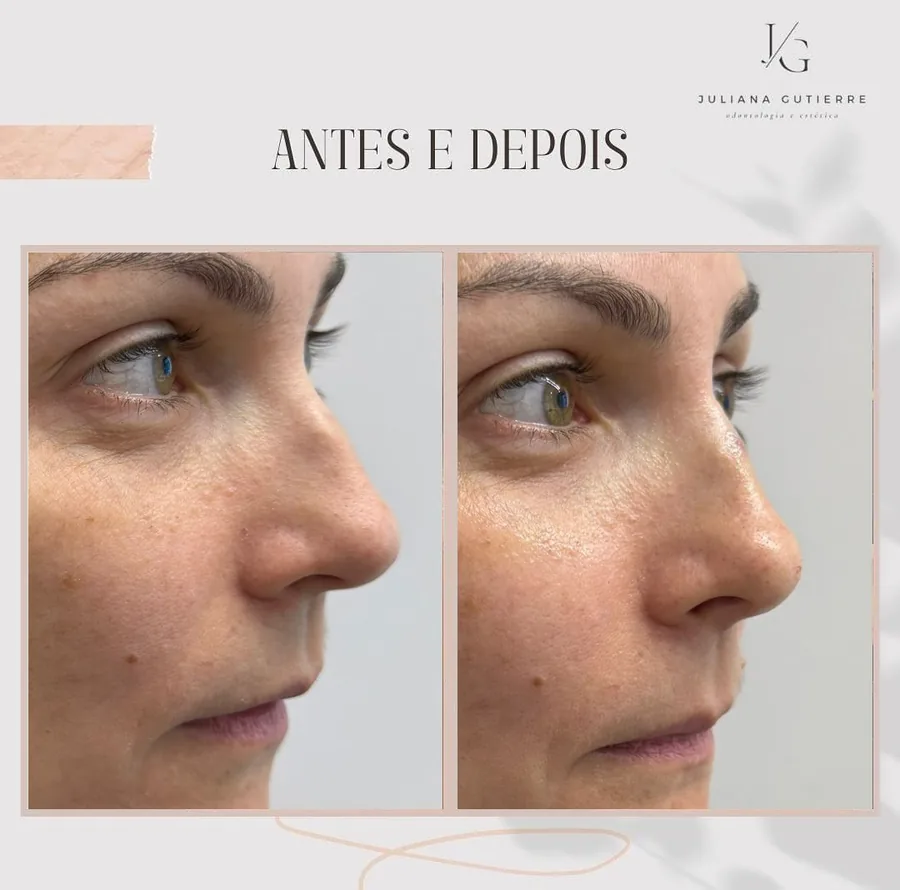 Antes e depois — região periorbital