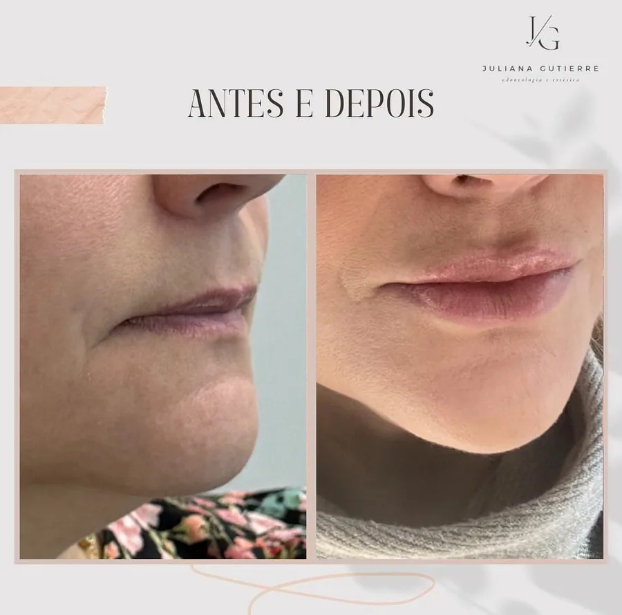 Antes e depois — preenchimento labial, perfil