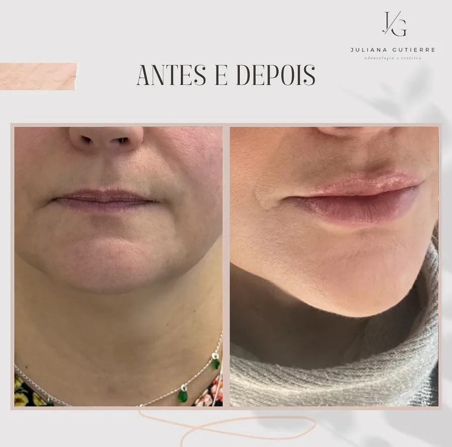 Antes e depois — contorno labial, frontal