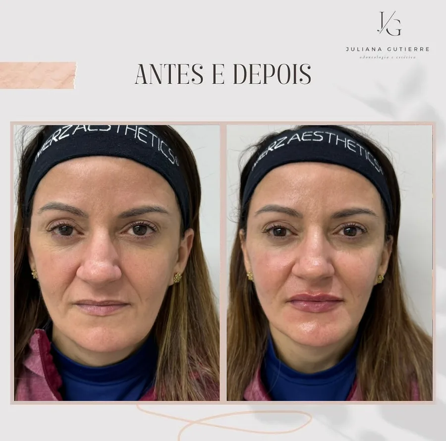 Antes e depois — harmonização orofacial, frontal