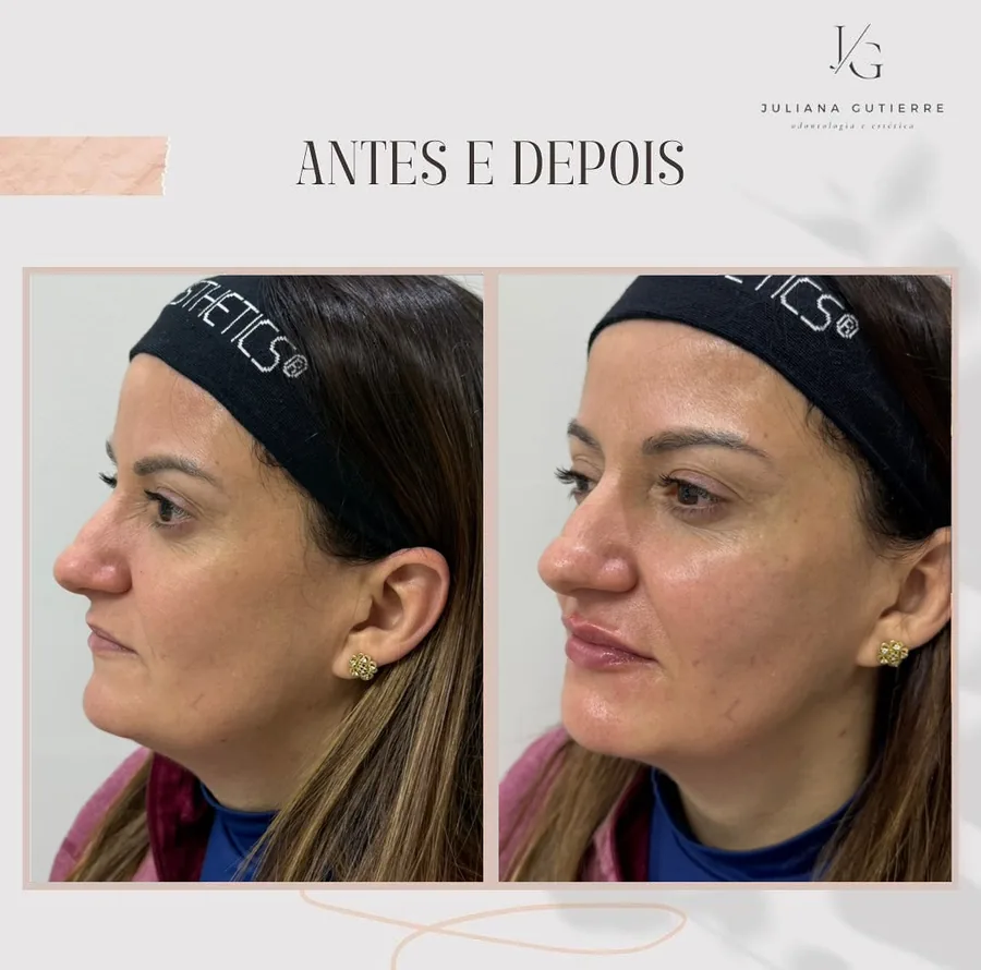 Antes e depois — harmonização orofacial, perfil