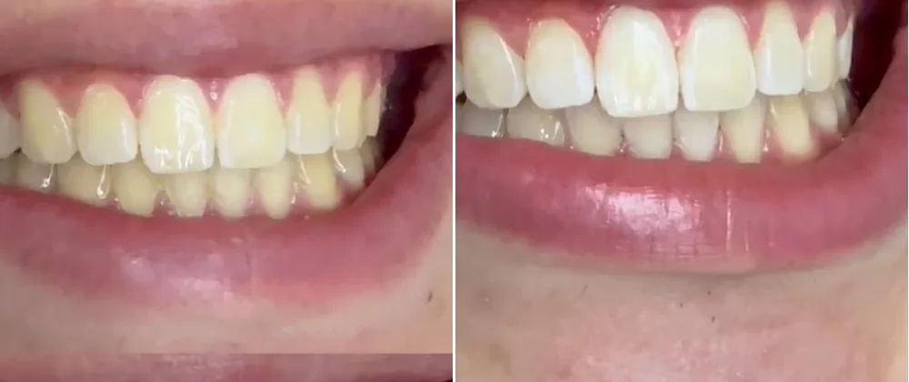 Antes e depois — clareamento dental