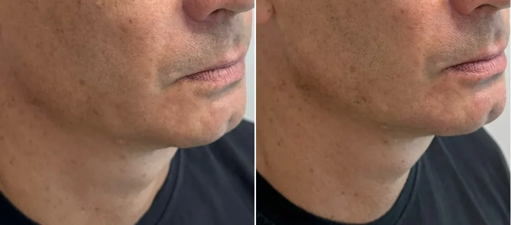 Antes e depois — contorno facial