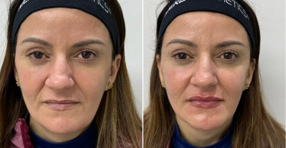 Antes e depois — harmonização orofacial