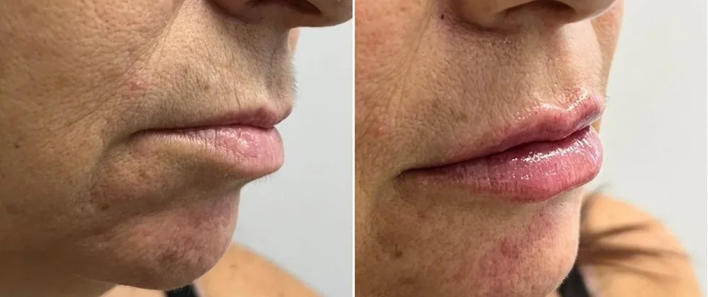 Antes e depois — preenchimento labial