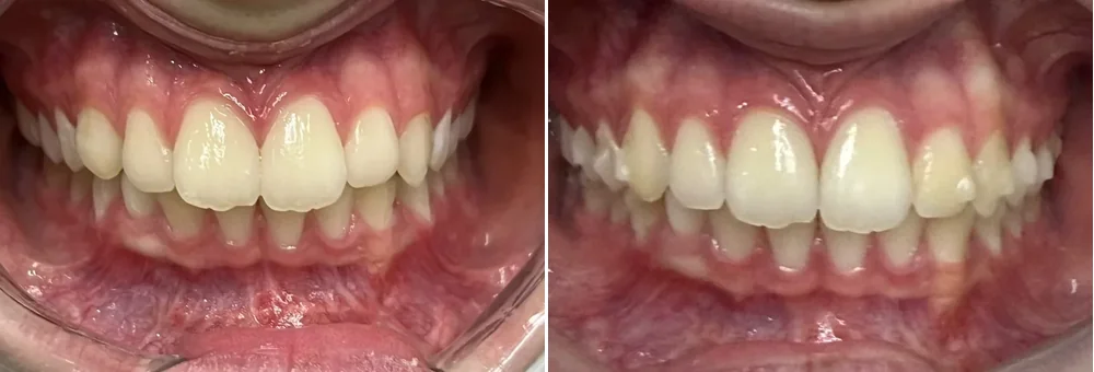 Antes e depois — ortodontia