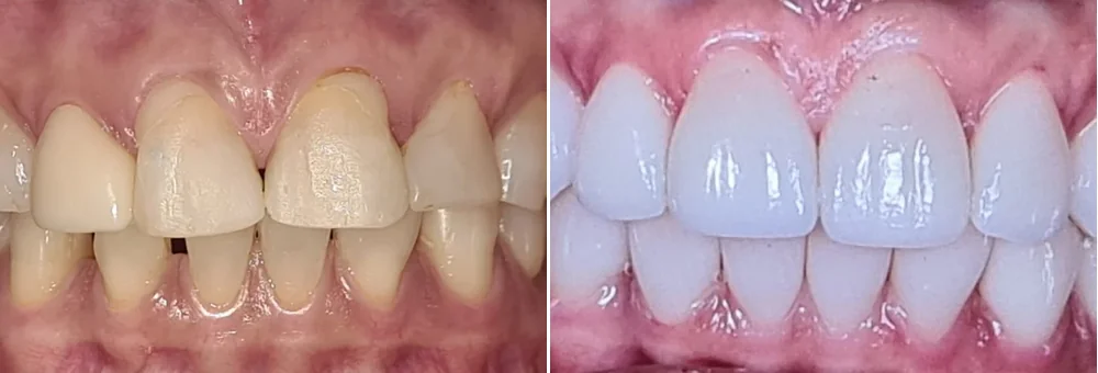 Antes e depois — estética do sorriso