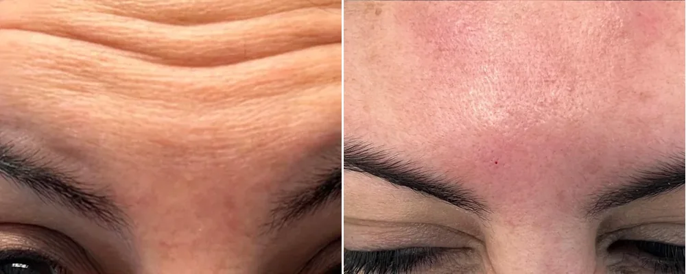 Antes e depois — toxina botulínica